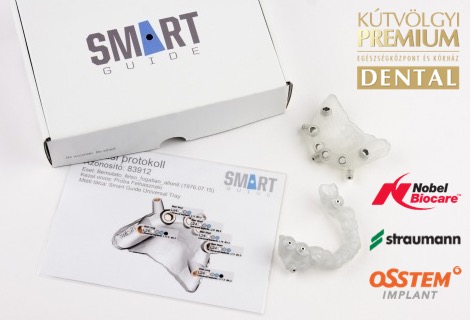 Digitális navigációs sablon minden implantátum típushoz - PREMIUM DENTAL fogászat, Budapest