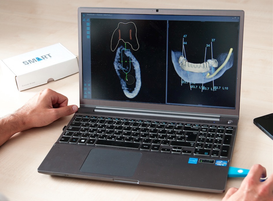 Digitálisan tervezett és minimál beavatkozással végzett fogbeültetés, gyorsabb gyógyulás - PREMIUM DENTAL fogászat, Budapest