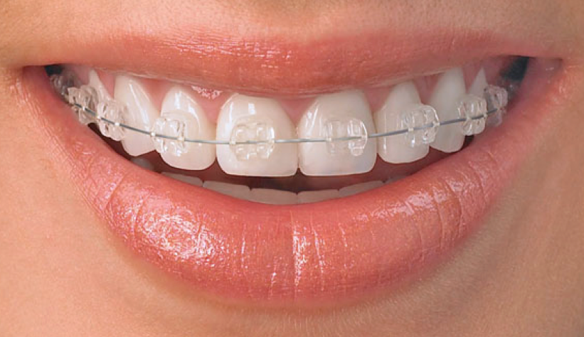 Fogszabályozás, szép, szabályos fogsor, magabiztos mosoly - PREMIUM DENTAL fogászat, Budapest